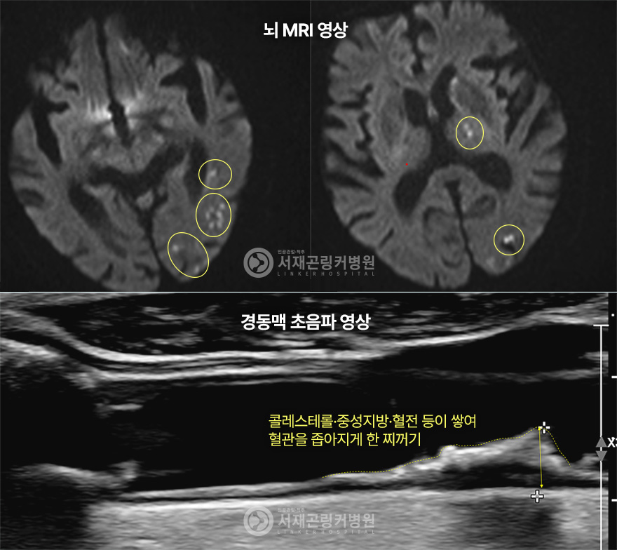 뇌 MRI 영상 | 경동맥 초음파 영상 - 콜레스테롤·중성지방·혈전 등이 쌓여 혈관을 좁아지게 한 찌꺼기