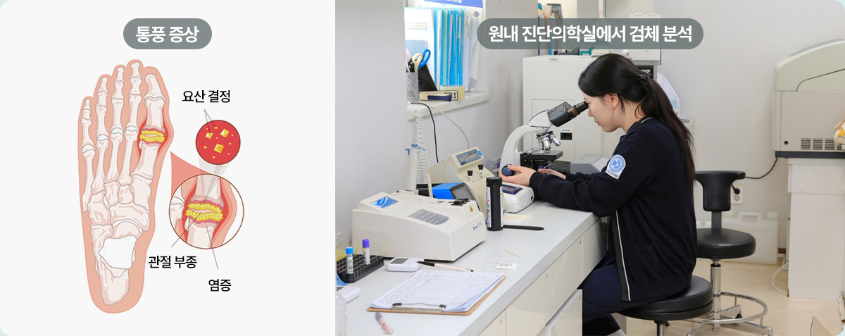 통풍 증상 | 원내 진단의학실에서 검체 분석