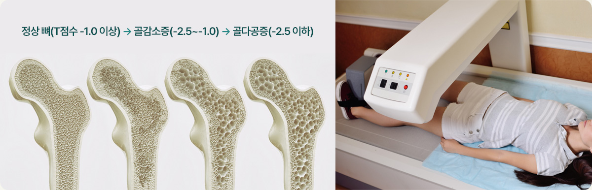 정상 뼈(T점수 -1.0 이상) → 골감소증(-2.5~-1.0) → 골다공증(-2.5 이하)