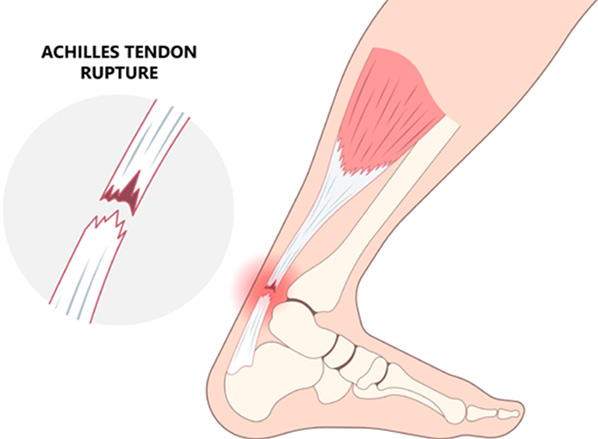 ACHILLES TENDON RUPTURE