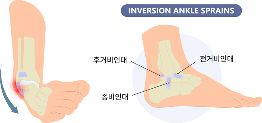 INVERSION ANKLE SPRAINS 후거비인대, 종비인대, 전거비인대