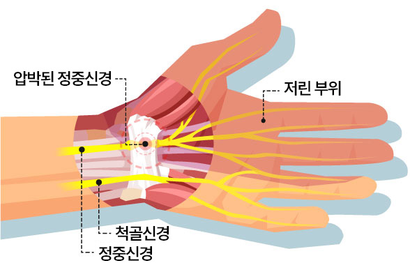 압박된 정중신경 | 저린 부위 | 척골신경 | 정중신경