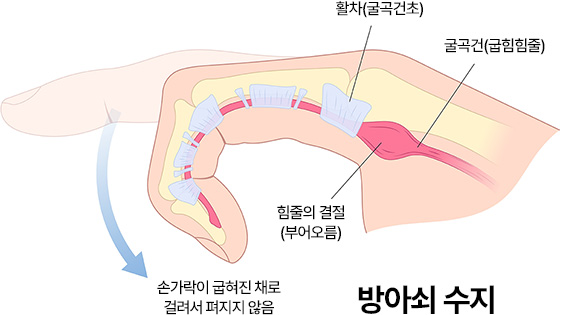 방아쇠 수지 - 활차(굴곡건초), 굴곡건(굽힘힘줄), 손가락이 굽혀진 채로 걸려서 펴지지 않음