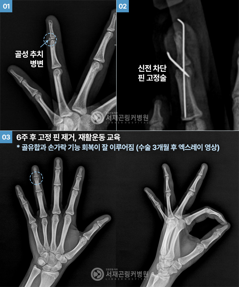 01. 골성 추치 병변 02. 신전 차단 핀 고정술 03. 6주 후 고정 핀 제거, 재활운동 교육 * 골유합과 손가락 기능 회복이 잘 이루어짐 (수술 3개월 후 엑스레이 영상)