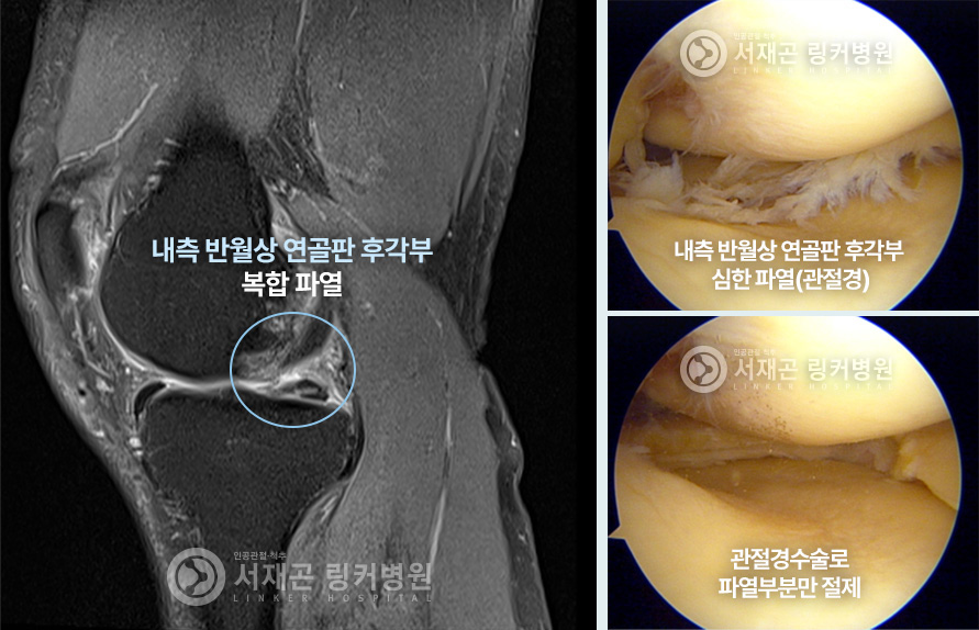 내측 반월상 연골판 후각부 복합 파열 | 내측 반월상 연골판 후각부 심한 파열(관절경) | 관절경수술로 파열부분만 절제