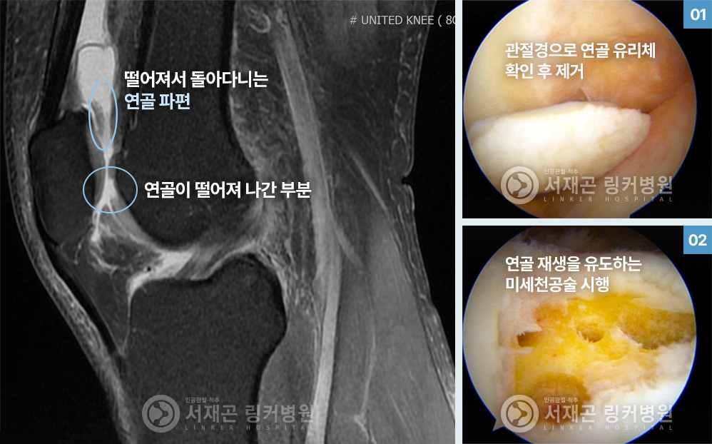 떨어져서 돌아다니는 연골 파편, 연골이 떨어져 나간 부분 | 관절경으로 연골 유리체 확인 후 제거 | 연골 재생을 유도하는 미세천공술 시행