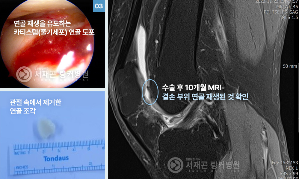 연골 재생을 유도하는 카티스템(줄기세포) 연골 도포 | 관절 속에서 제거한 연골 조각 | 수술 후 10개월 MRI-결손 부위 연골 재생된 것 확인
