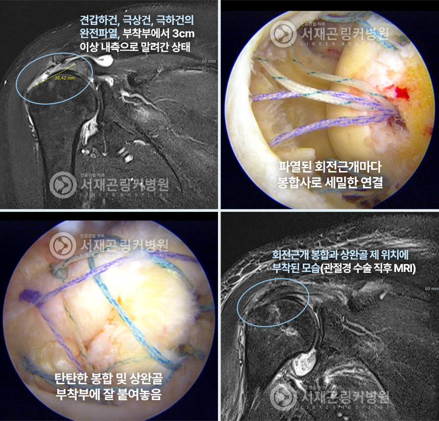 견갑하건, 극상건, 극하건의 완전파열, 부착부에서 3cm 이상 내측으로 말려간 상태 | 파열된 회전근개마다 봉합사로 세밀한 연결 | 탄탄한 봉합 및 상완골 부착부에 잘 붙여놓음 | 회전근개 봉합과 상완골 제 위치에 부착된 모습(관절경 수술 직후 MRI)