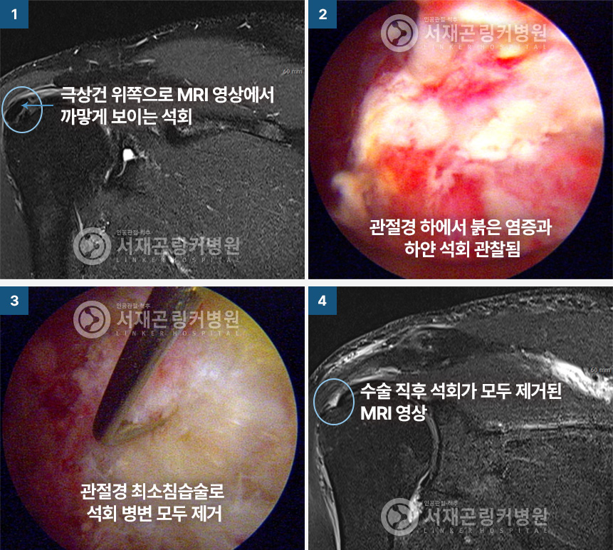 극상건 위쪽으로 MRI 영상에서 까맣게 보이는 석회 | 관절경 하에서 붉은 염증과 하얀 석회 관찰됨 | 관절경 최소침습술로 석회 병변 모두 제거 | 수술 직후 석회가 모두 제거된 MRI 영상