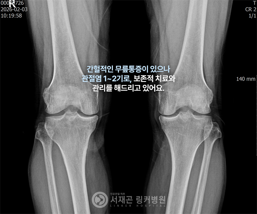 간헐적인 무릎통증이 있으나 관절염 1~2기로, 보존적 치료와 관리를 해드리고 있어요.