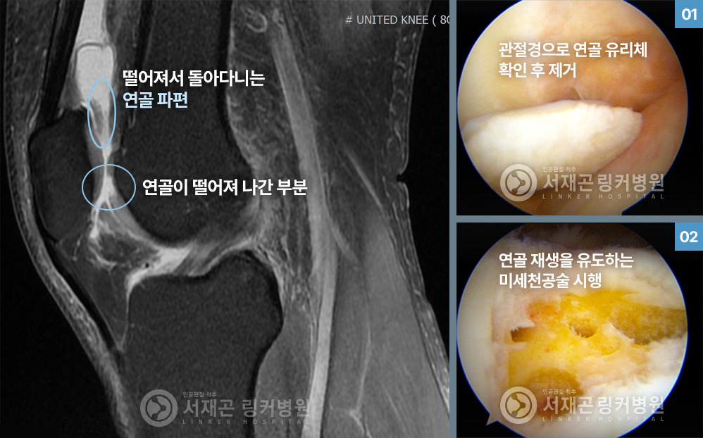 떨어져서 돌아다니는 연골 파편, 연골이 떨어져 나간 부분 | 관절경으로 연골 유리체 확인 후 제거 | 연골 재생을 유도하는 미세천공술 시행