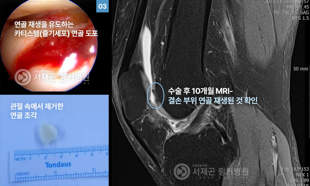 연골 재생을 유도하는 카티스템(줄기세포) 연골 도포 | 관절 속에서 제거한 연골 조각 | 수술 후 10개월 MRI-결손 부위 연골 재생된 것 확인