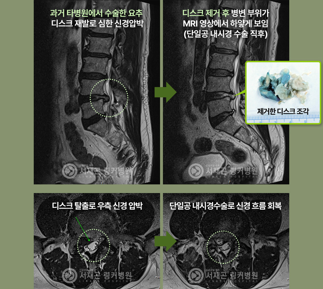과거 타병원에서 수술한 요추 디스크 재발로 심한 신경압박 > 디스크 제거 후 병변 부위가 MRI 영상에서 하얗게 보임(단일공 내시경 수술 직후) | 디스크 탈출로 우측 신경 압박 > 단일공 내시경수술로 신경 흐름 회복