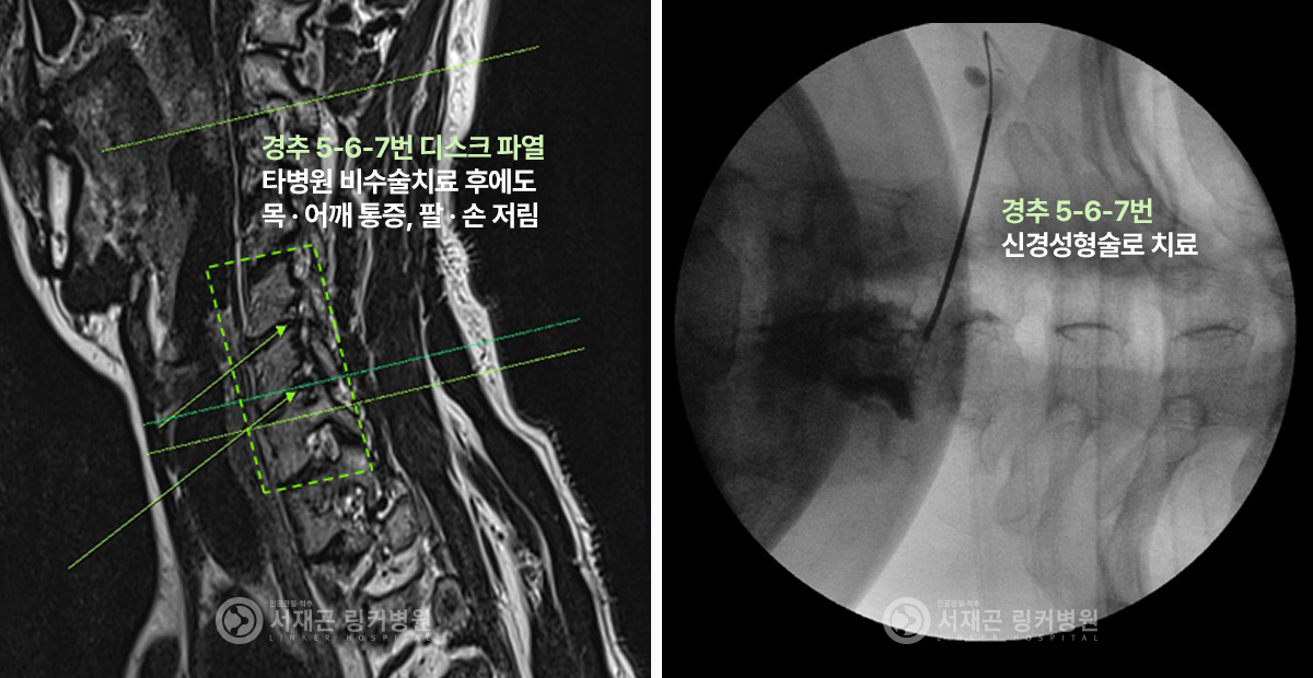 경추 5-6-7번 디스크 파열 타병원 비수술 치료 후에도 목 · 어깨 통증, 팔 · 손 저림 | 경추 5-6-7번 신경성형술로 치료