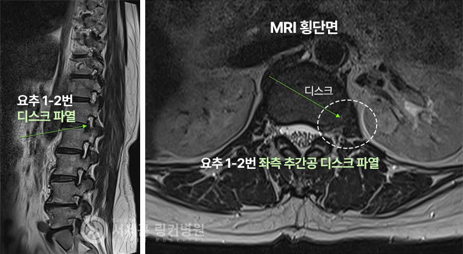 요추 1-2번 디스크 파열 | 요추 1-2번 좌측 추간공 디스크 파열