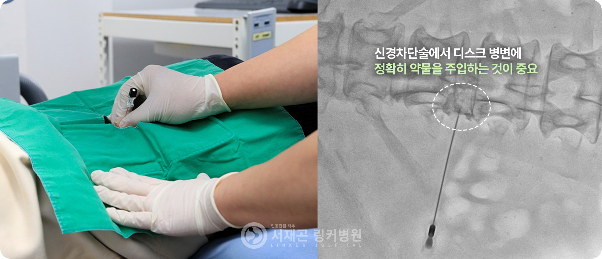 신경차단술에서 디스크 병변에 정확히 약물을 주입하는 것이 중요