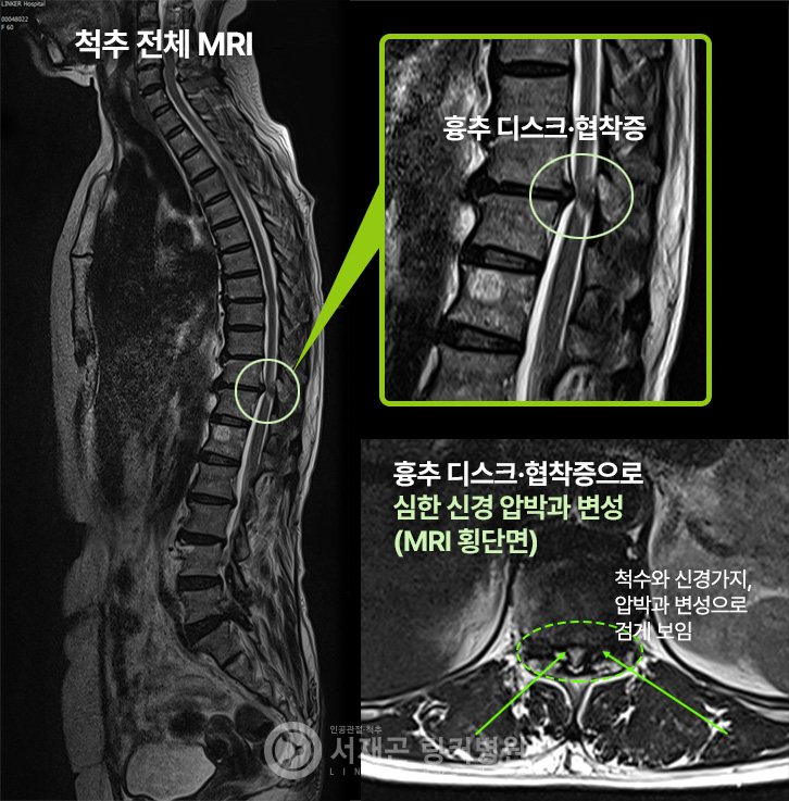 흉추 디스크·협착증으로 심한 신경 압박과 변성(MRI 횡단면)