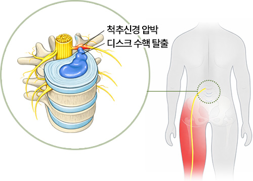 척추신경 압박 디스크 수핵 탈출