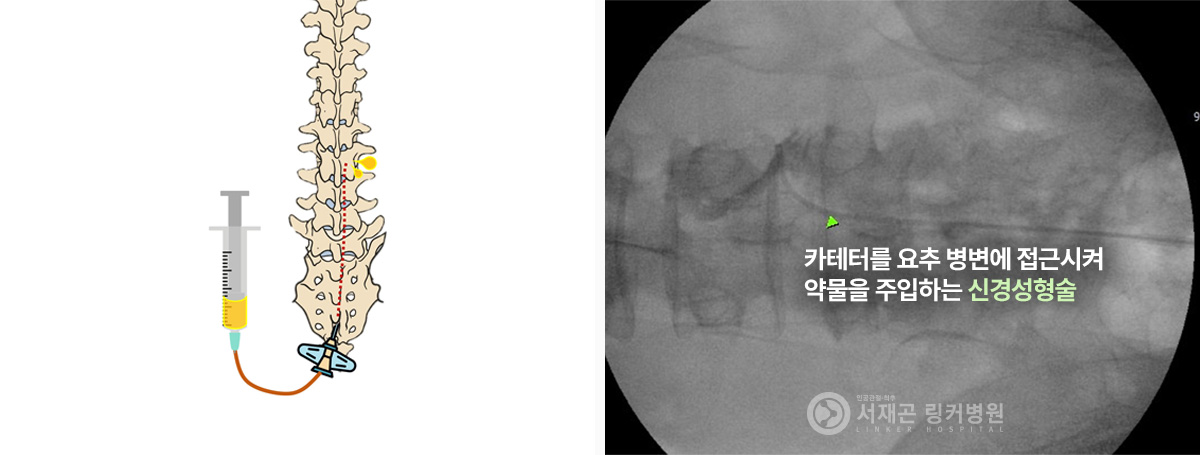 카테터를 요추 병변에 접근시켜 약물을 주입하는 신경성형술